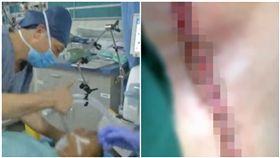 電鋸突脫手！男「頸到胸」遭一刀劈開（圖／翻攝自看看新聞）