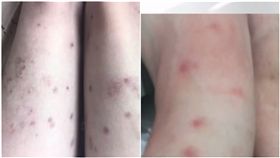 泰國日前發生一起離奇病例，一名16歲少女某日突然全身紅腫、發高燒，四處求醫後病情還是沒有好轉，少女便突然暴斃離世，讓家屬十分傷心，他們懷疑少女是因為被跳蚤叮咬才會引發過敏，並把跳蚤的來源怪罪給家裡的貓咪、決定要將貓咪們棄養。但事情爆發後，就有醫生懷疑少女根本不是因為被跳蚤咬傷才發病，而是罹患了「紅斑性狼瘡」。（圖／翻攝自TNAMCOT YouTube）