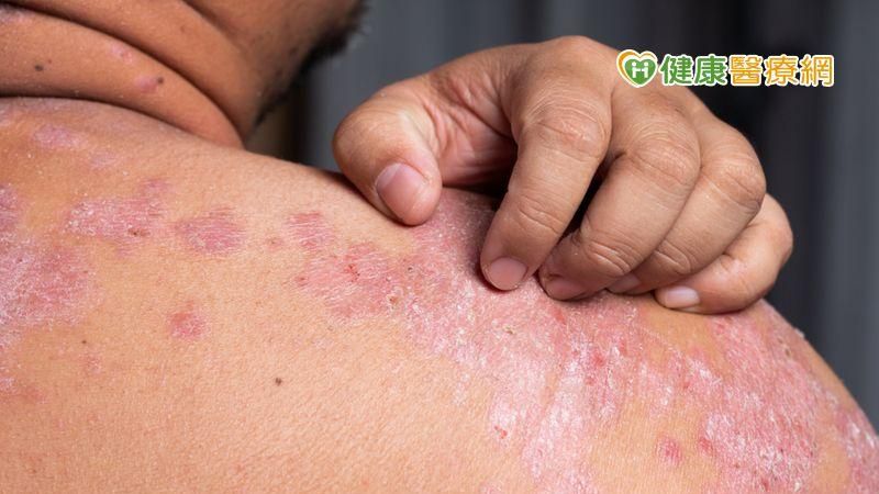 患乾癬紅皮症　積極治療遠離危「癬」