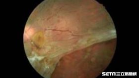 視網膜剝離影像。白色薄膜就是視網膜，已經脫離後面應當附著的眼球壁。（圖／醫師黃奕修提供）