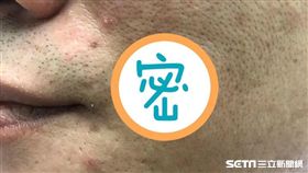 40歲患者王先生買「天然草本除痣膏」，塗抹於黑痣上竟造成化學性灼傷。（圖／醫師黃昭瑜提供）