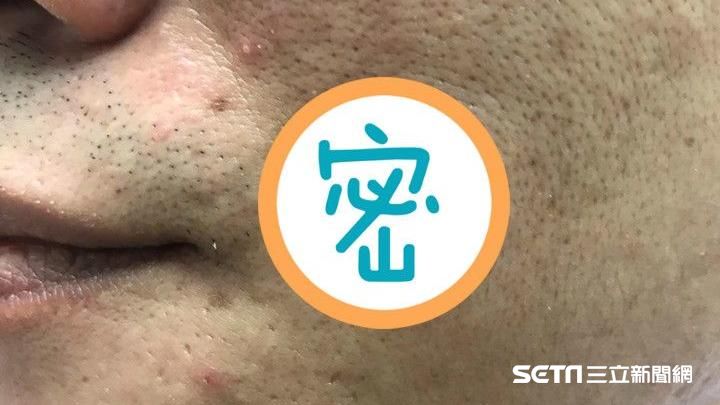 驚！愛美除痣竟燒成「噴膿大黑洞」！