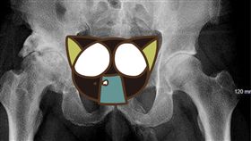 陰莖,海綿體,鈣化,骨折,老翁,彎曲,勃起功能障礙,畸形,紐約,美國, 圖／翻攝自推特