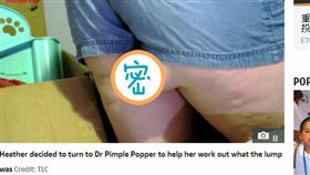 美國,孕婦,腫塊,腫瘤,脂肪,尾巴
https://www.thesun.co.uk/news/9682373/mum-penis-shaped-growth-bum-removed/?utm_medium=Social&utm_campaign=sunmaintwitter&utm_source=Twitter#Echobox=1565346004