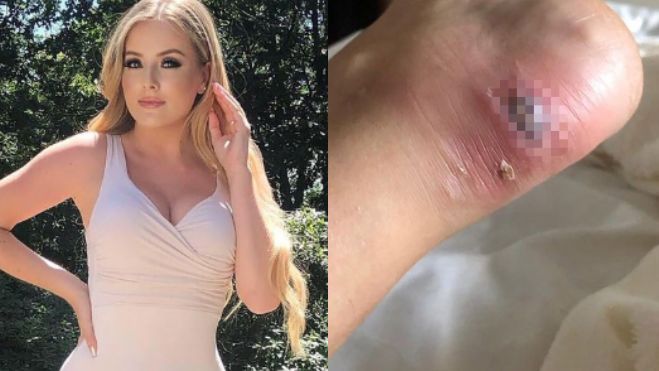 正妹穿涼鞋磨腳起水泡　爆膿液險截肢