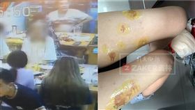 火鍋人人愛吃，但吃火鍋時民眾一定要當心，日前大陸一名女子和朋友一起外出到知名火鍋店用餐，想不到一行人才開動沒多久，火鍋的鍋底卻突然爆炸，導致火鍋湯汁四濺，造成現場多人燙傷。其中受傷最嚴重的就是這名穿著短褲的女子，她在被熱湯噴到後緊急送往醫院作處置，但醫生表示這個燙傷因為還有摻雜熱油，導致皮膚受損嚴重，因此她恐怕得永遠留疤。（圖／翻攝自梨子視頻）
