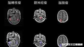 人工智慧自動圈選三種最常見腦瘤。（圖／台大醫院提供）