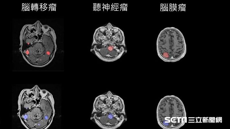 電腦刀結合AI！台大醫院找秒揪腦瘤