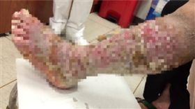 肺癌,病理性骨折,淋巴水腫,水桶,靜脈吻合術　圖／高雄長庚