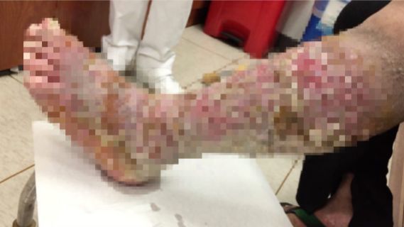 慘！他腿破3百個洞　狂流淋巴液臭炸