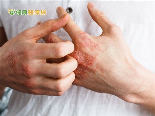 乾癬患者求職屢碰壁 積極治療早日正常生活