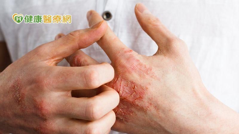 乾癬患者求職屢碰壁　治療可回歸正常