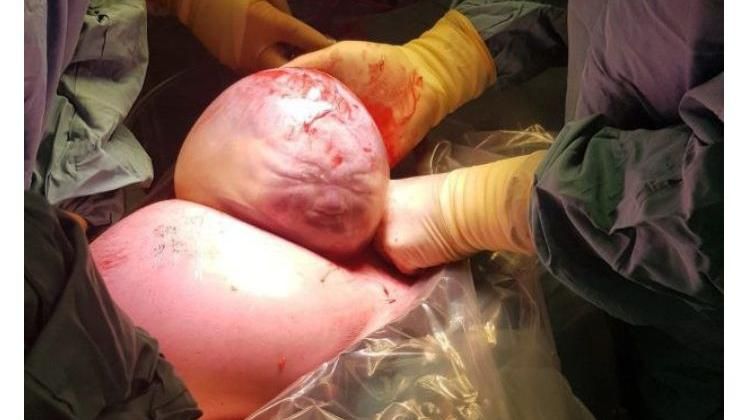 她剖腹產子…醫驚呆！頭裹羊膜超詭異