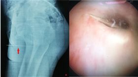性怪癖,縫衣針,尿道,刺激,內向,突尼西亞,醫師,精神科, 圖／翻攝自ScienceDirect