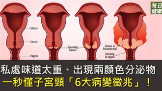 私處出現顏色分泌物？當心子宮頸病變