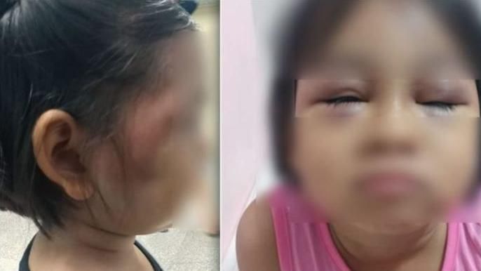 女童數學算得慢　被狠師持棍打成豬頭