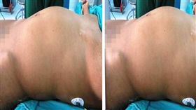 少女肚詭隆起　剖開見「雙胞胎半屍」（圖／翻攝自英國醫學期刊）