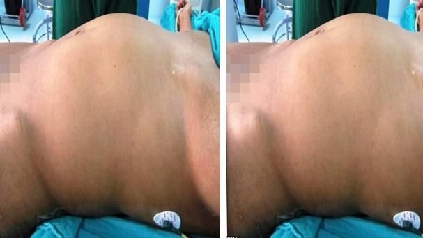 少女肚詭隆起　剖開見「雙胞胎半屍」