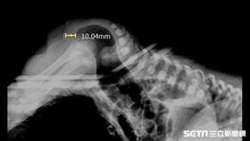 台北慈濟醫院小兒外科主任陳克琦透過倒立攝影檢查，發現黃小弟直腸距離肛門約10.04mm，診斷為低位無肛症。（圖／台北慈濟醫院提供）