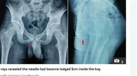 性癖,性愛,突尼西亞,少年,尿道,縫衣針,排尿
太陽報