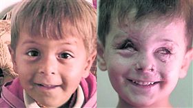 敘利亞,戰火,失明,Jouma,戰爭,逃亡,空襲,毀容,傷痕,生活,笑容,難民,勵志　圖／翻攝自YouTube