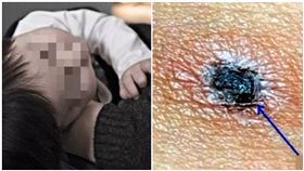  恙蟲病，恙蟲，叮咬（圖／翻攝自都市頻道、pixabay）