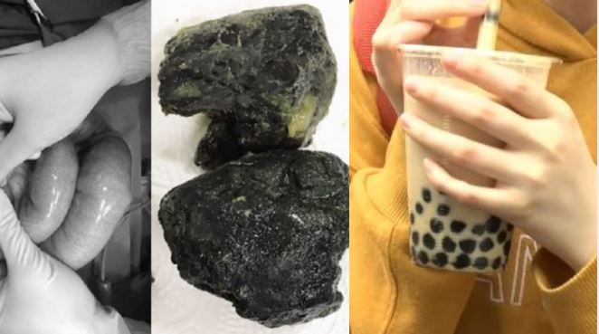 20歲男愛珍奶！肚內挖出「黑礦石」