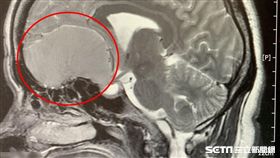50歲患者吳女士腦部電腦斷層掃描側面圖。（圖／台北慈濟醫院提供）