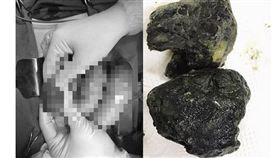 天天喝珍奶！男肚痛嘔吐　腸道竟藏2大塊「黑礦石」(圖/翻攝自vietnamnet)