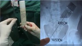 大陸一名15歲少年日前竟因為一時好奇，把一罐噴氣的鋼瓶塞入自己的肛門內，他本以為可以順利取出，但想不到鋼瓶卻越陷越深，直接跑進腹部，無奈之下，少年只好忍痛多日，直到身體出現異狀後才跟父母坦承實情，之後便立刻送醫治療，所幸最後在醫師的幫助下順利將鋼瓶取出。（圖／翻攝自荔視頻）