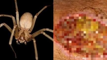 劇毒蜘蛛躲耳裡　被咬傷流黃膿見紅肉