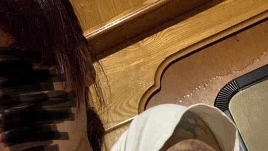 正妹肚痛扎針　一周後手臂竟佈滿紋路