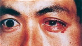 淋病,淋菌性結膜炎,淋病,眼睛,健康,眼科,長庚,陳宏吉, 圖／翻攝自百度百科