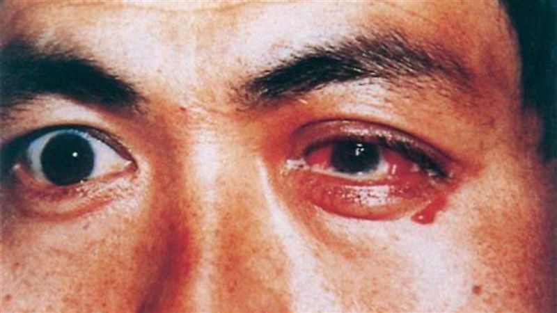 平時私生活不檢點　小心眼角膜遭溶解