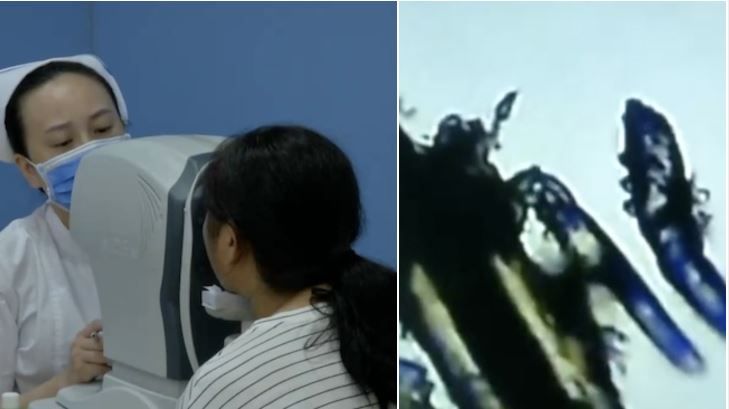眼內數條活蟲蠕動！竟因她每天化妝