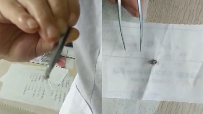 她頭長腫包取出X蟲　驚見倒勾口器