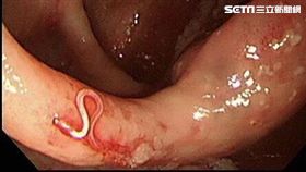 愛吃生魚片…他腸壁驚見20隻蟲鑽動