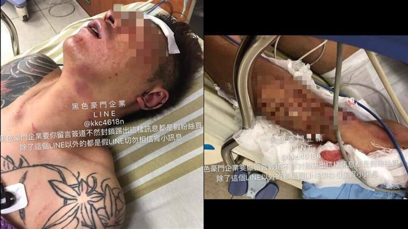 吳小哲直播曬手腳…爆哭憂百萬醫藥費