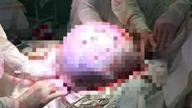 俄羅斯,卵巢瘤。(圖/翻攝自dailymail)