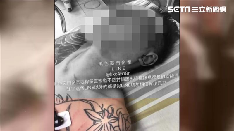 毆打吳小哲恐截肢？世仇包龍星回應了