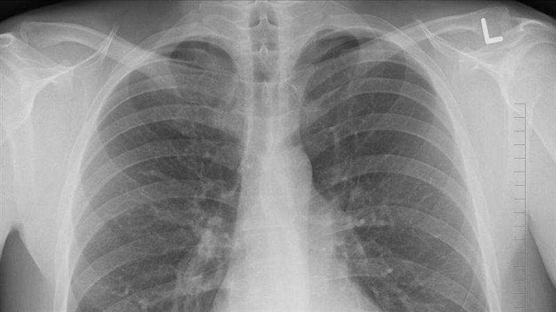 醫師表示．肺結核是由結核菌所引起的傳染病，因症狀不典型，容易讓病人本身及醫師延誤了診斷。（示意圖／資料照）