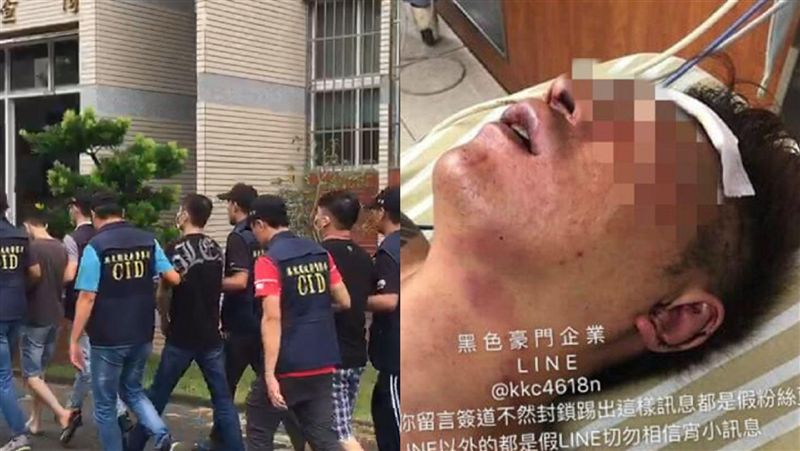 吳小哲近照曝光！粉碎性骨折支架插肉