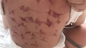 刮痧,捏沙,大陸,發燒,捏痧,軟組織,瘀斑,民俗療法,腎臟,健康,　圖／翻攝自微博