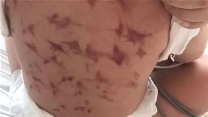 孫發燒祖母幫「捏痧」　醫：母湯啊