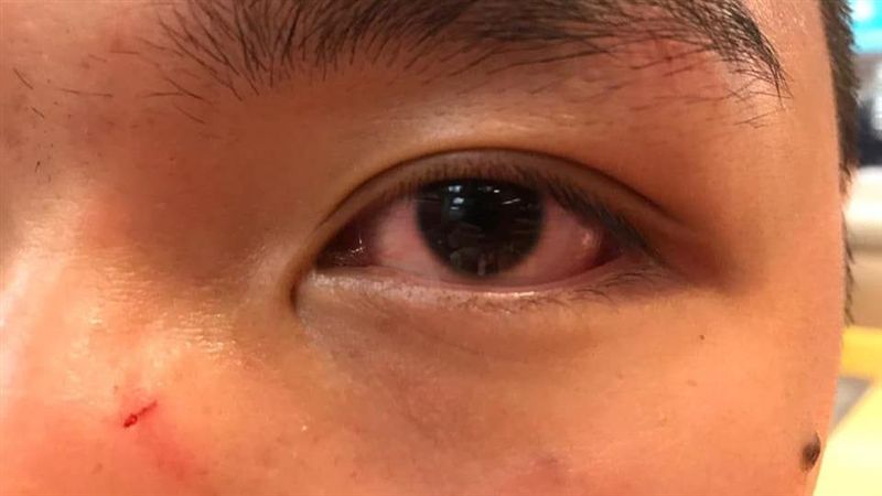 眼鏡噴飛！眾志鄭家朗遭3男揮拳打傷