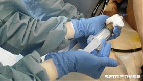 植入微菌叢。（圖／台北榮總提供）