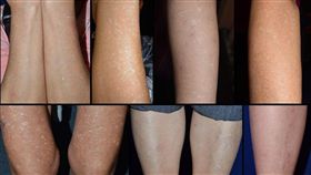 成大醫院,皮膚部,陳郁蓁,特發性滴狀黑色素減少症,皮膚病,白斑
圖／翻攝自成大醫院臉書