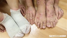 兄妹倆因罹患嚴重異位性皮膚炎，全身掻癢抓到體無完膚。（圖／台中慈濟醫院提供）