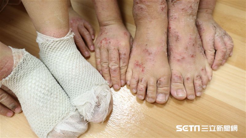 抓到狂流血！4歲童因這病體無完膚