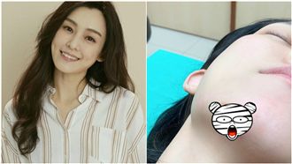 范瑋琪又慘摔！下巴縫15針血肉全露